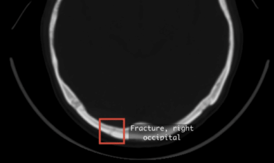 Neurocritical AI solution to be deployed into A&E At MKUH